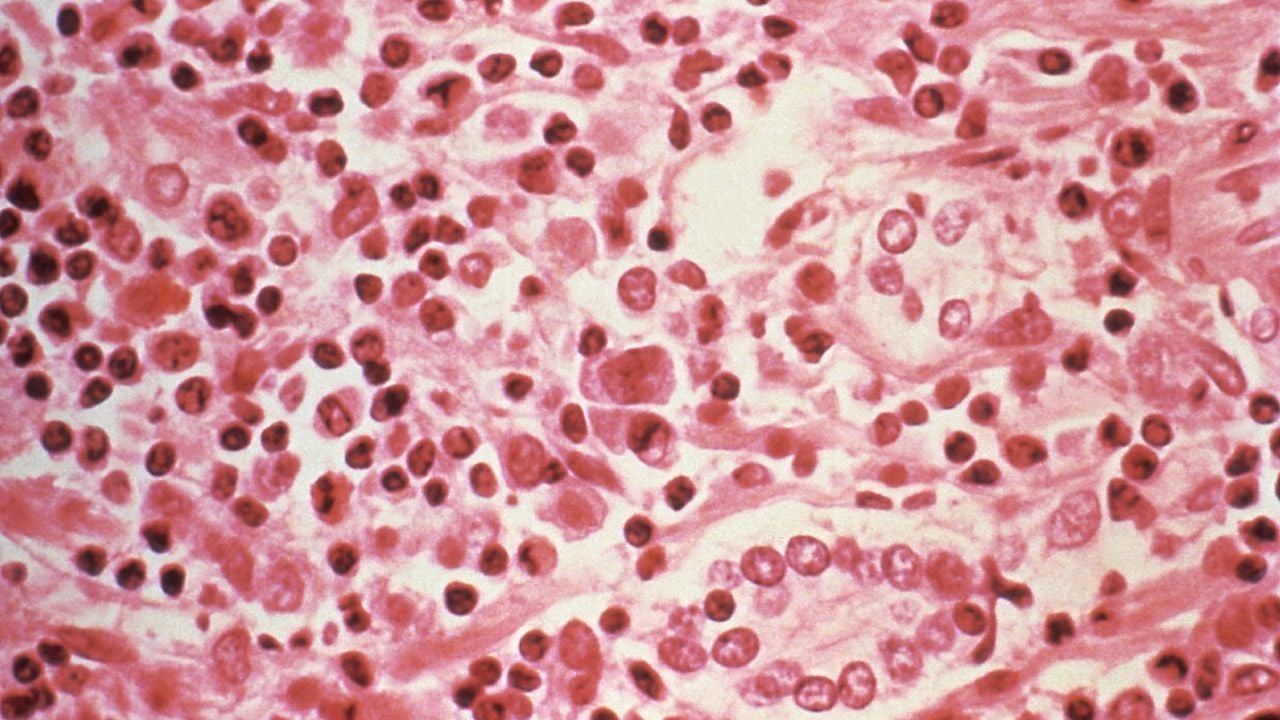 Tres pacientes con hantavirus evacuados de crucero en Países Bajos, estado crítico